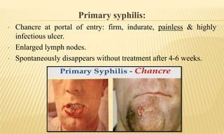 Primary syphilis:
• Chancre at portal of entry: firm, indurate, painless & highly
infectious ulcer.
• Enlarged lymph nodes.
• Spontaneously disappears without treatment after 4-6 weeks.
 