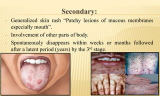Secondary:
• Generalized skin rash “Patchy lesions of mucous membranes
especially mouth”.
• Involvement of other parts of body.
• Spontaneously disappears within weeks or months followed
after a latent period (years) by the 3rd stage.
 