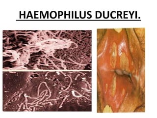 HAEMOPHILUS DUCREYI.
 