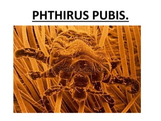 PHTHIRUS PUBIS.
 