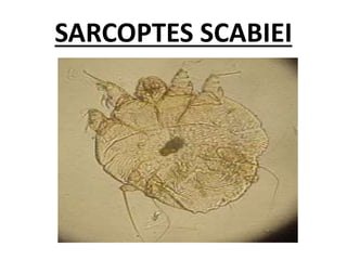 SARCOPTES SCABIEI
 