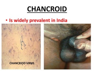 CHANCROID
• Is widely prevalent in India
CHANCRIOD VIRUS
 