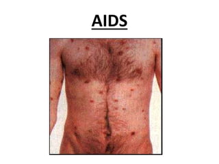 AIDS
 