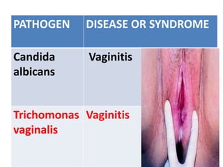 PATHOGEN DISEASE OR SYNDROME
Candida
albicans
Vaginitis
Trichomonas
vaginalis
Vaginitis
 