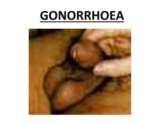 GONORRHOEA
 
