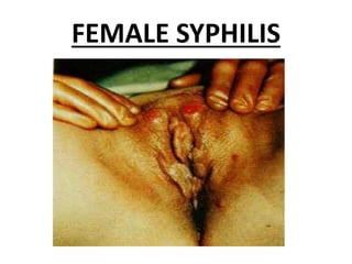FEMALE SYPHILIS
 