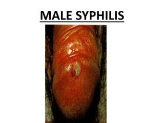 MALE SYPHILIS
 