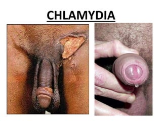 CHLAMYDIA
 