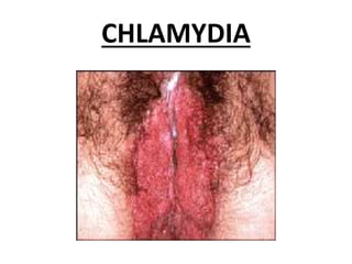 CHLAMYDIA
 