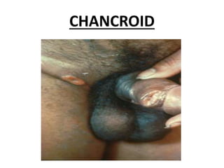 CHANCROID
 