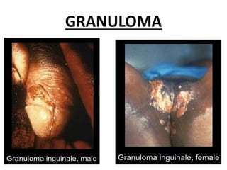 GRANULOMA
 