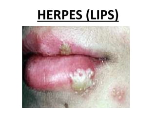 HERPES (LIPS)
 