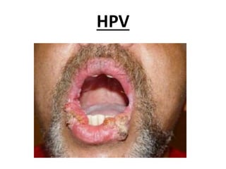 HPV
 