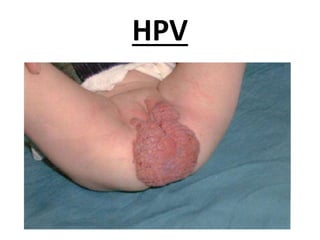 HPV
 