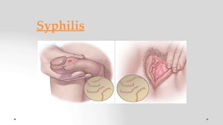 Syphilis
 