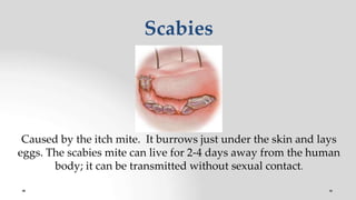 Scabies
Caused by the itch mite. It burrows just under the skin and lays
eggs. The scabies mite can live for 2-4 days away from the human
body; it can be transmitted without sexual contact.
 