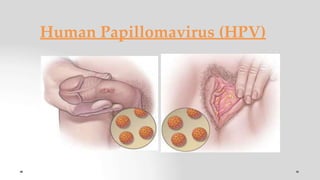 Human Papillomavirus (HPV)
 