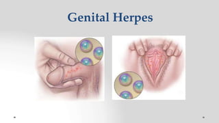 Genital Herpes
 