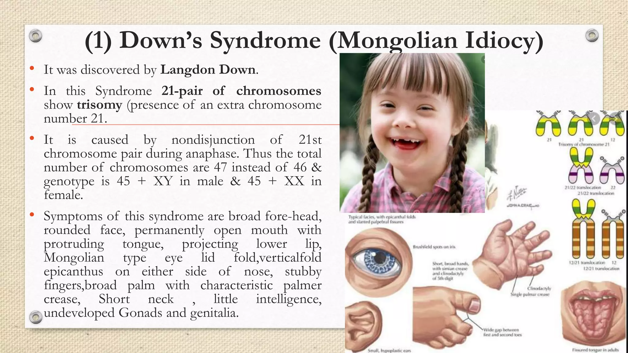 (1) Down’s Syndrome (Mongolian Idiocy)
• It was discovered by Langdon Down.
• In this Syndrome 21-pair of chromosomes
show trisomy (presence of an extra chromosome
number 21.
• It is caused by nondisjunction of 21st
chromosome pair during anaphase. Thus the total
number of chromosomes are 47 instead of 46 &
genotype is 45 + XY in male & 45 + XX in
female.
• Symptoms of this syndrome are broad fore-head,
rounded face, permanently open mouth with
protruding tongue, projecting lower lip,
Mongolian type eye lid fold,verticalfold
epicanthus on either side of nose, stubby
fingers,broad palm with characteristic palmer
crease, Short neck , little intelligence,
undeveloped Gonads and genitalia.
 