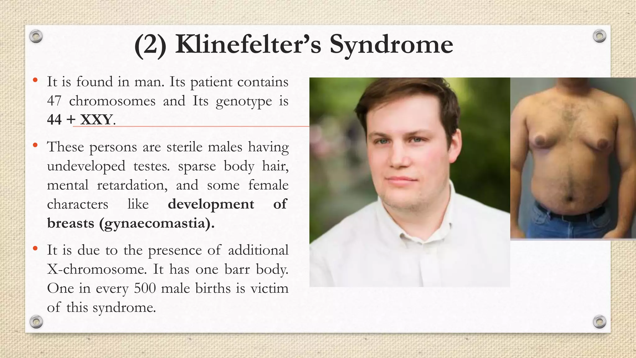 (2) Klinefelter’s Syndrome
• It is found in man. Its patient contains
47 chromosomes and Its genotype is
44 + XXY.
• These persons are sterile males having
undeveloped testes. sparse body hair,
mental retardation, and some female
characters like development of
breasts (gynaecomastia).
• It is due to the presence of additional
X-chromosome. It has one barr body.
One in every 500 male births is victim
of this syndrome.
 