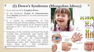 (1) Down’s Syndrome (Mongolian Idiocy)
• It was discovered by Langdon Down.
• In this Syndrome 21-pair of chromosomes
show trisomy (presence of an extra chromosome
number 21.
• It is caused by nondisjunction of 21st
chromosome pair during anaphase. Thus the total
number of chromosomes are 47 instead of 46 &
genotype is 45 + XY in male & 45 + XX in
female.
• Symptoms of this syndrome are broad fore-head,
rounded face, permanently open mouth with
protruding tongue, projecting lower lip,
Mongolian type eye lid fold,verticalfold
epicanthus on either side of nose, stubby
fingers,broad palm with characteristic palmer
crease, Short neck , little intelligence,
undeveloped Gonads and genitalia.
 