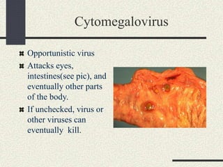 Cytomegalovirus
Opportunistic virus
Attacks eyes,
intestines(see pic), and
eventually other parts
of the body.
If unchecked, virus or
other viruses can
eventually kill.
 