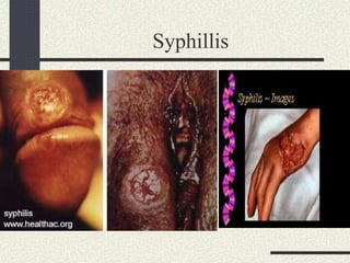 Syphillis
 