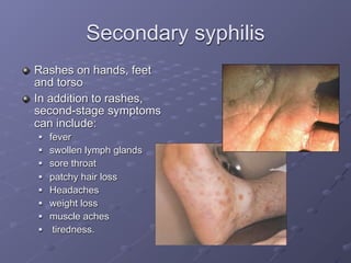 Secondary syphilis
Rashes on hands, feet
and torso
In addition to rashes,
second-stage symptoms
can include:
   fever
   swollen lymph glands
   sore throat
   patchy hair loss
   Headaches
   weight loss
   muscle aches
    tiredness.
 