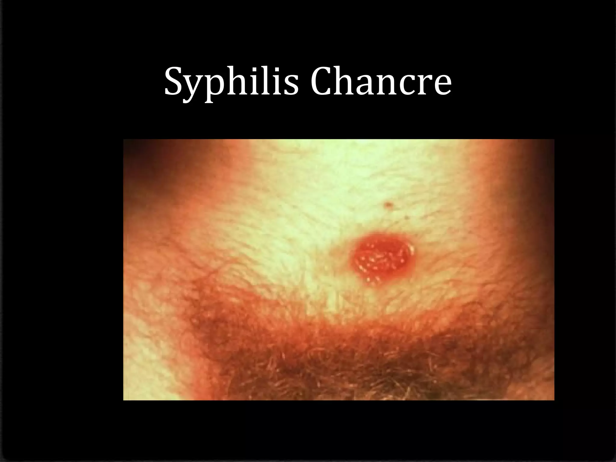Syphilis Chancre
 