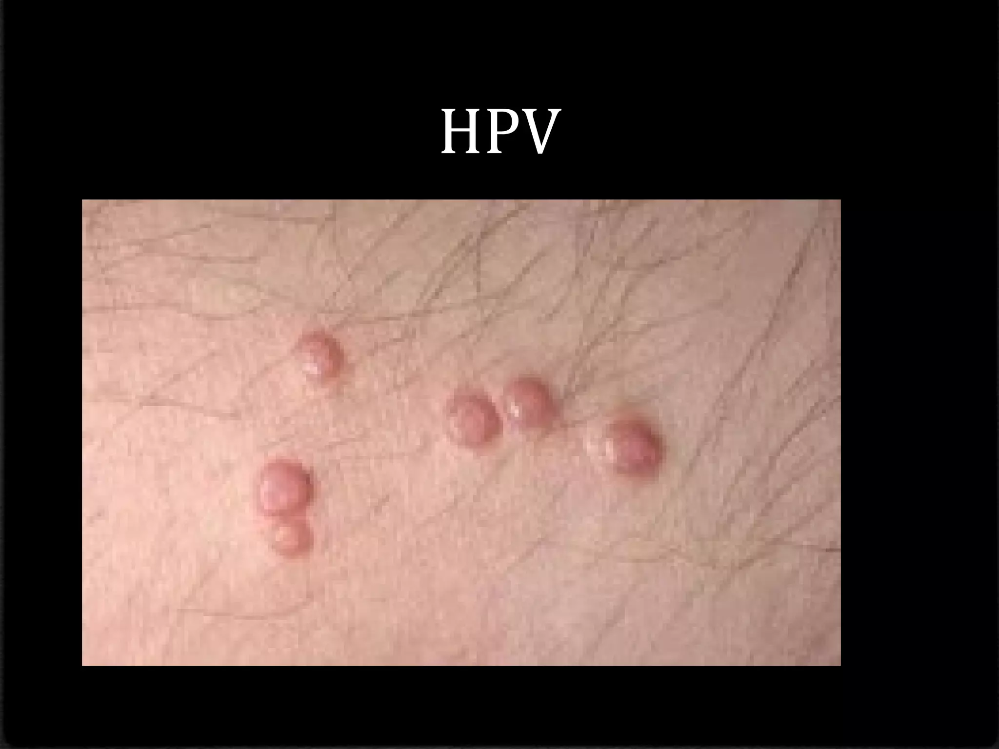 HPV
 