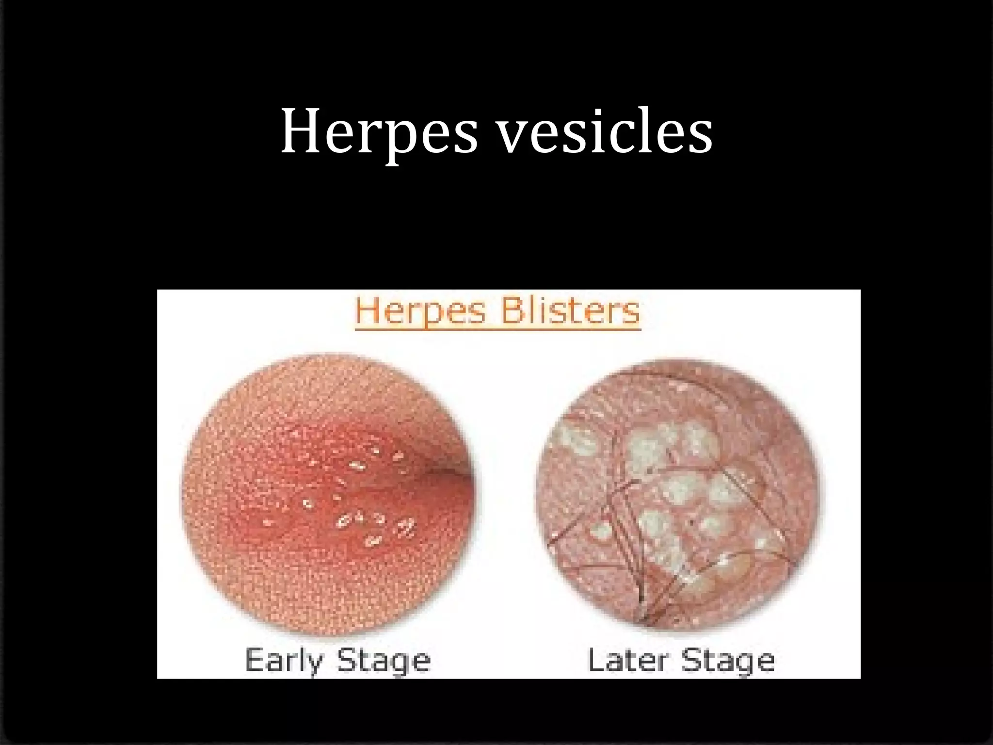 Herpes vesicles
 