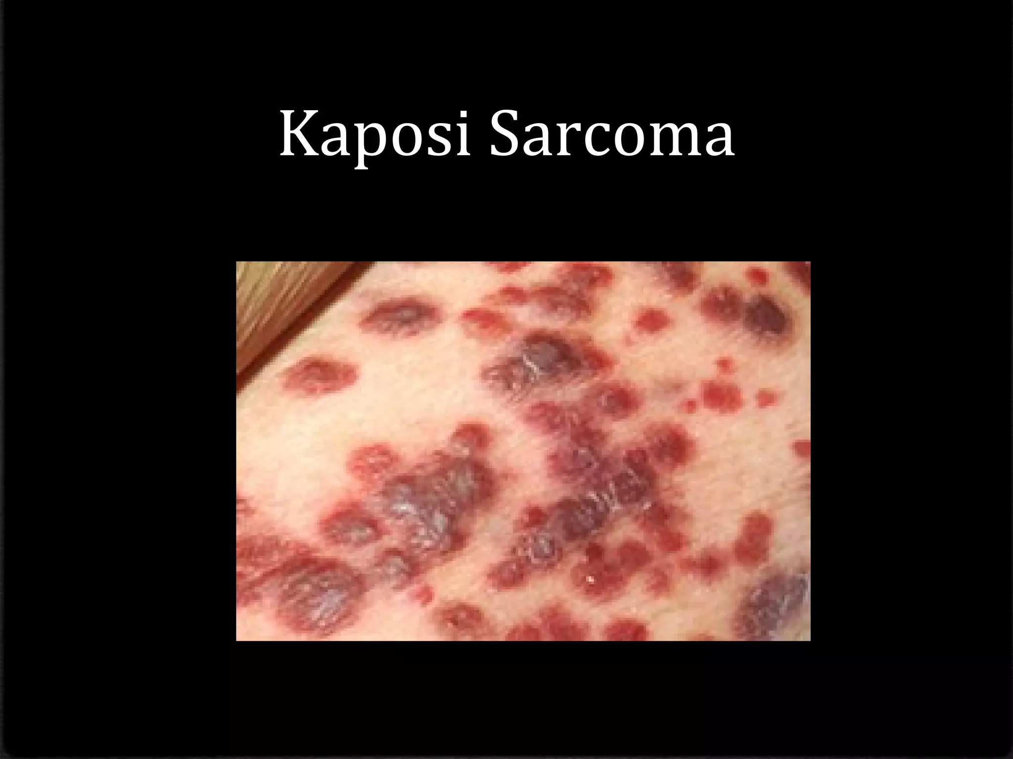 Kaposi Sarcoma
 