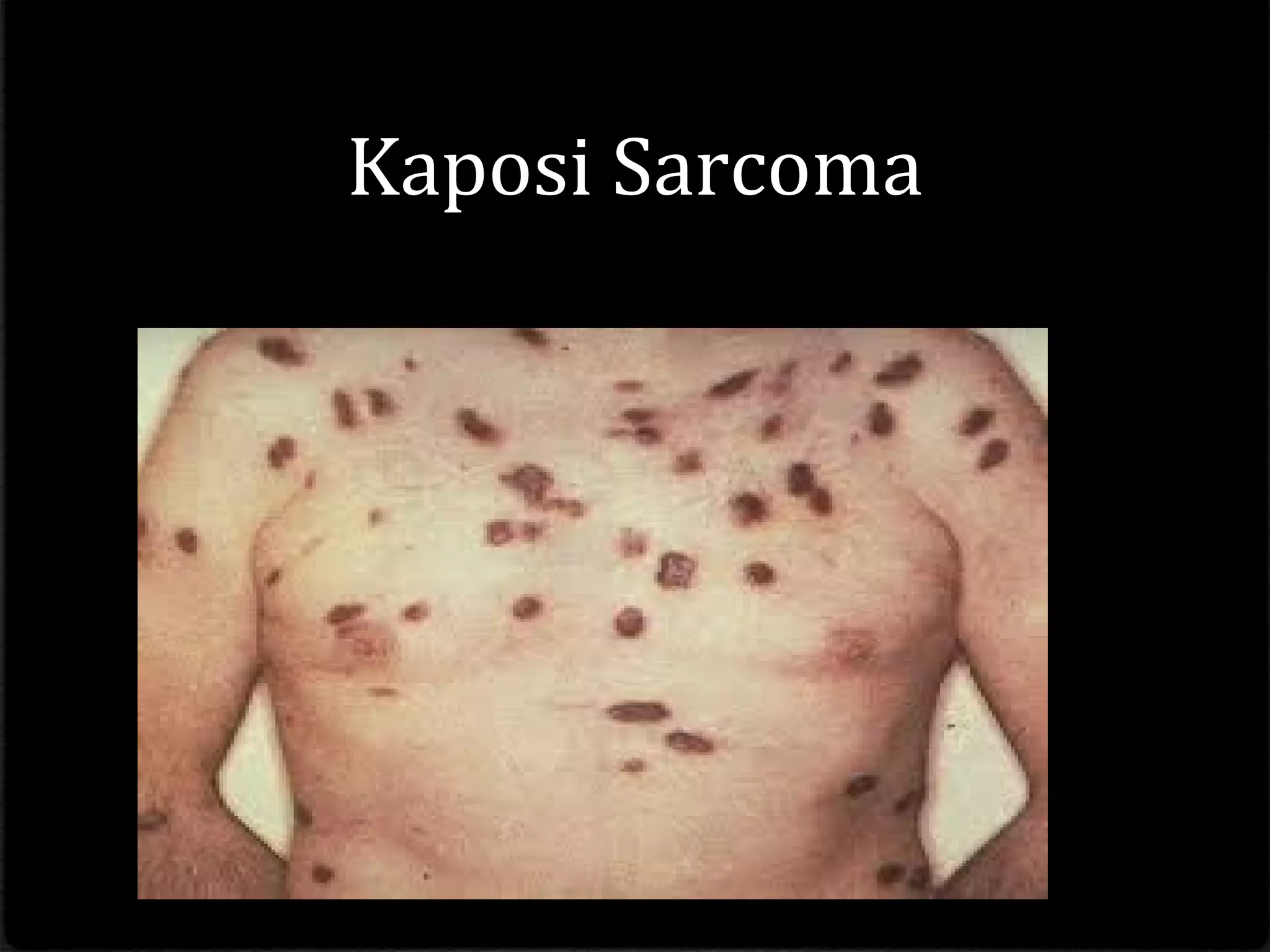 Kaposi Sarcoma
 