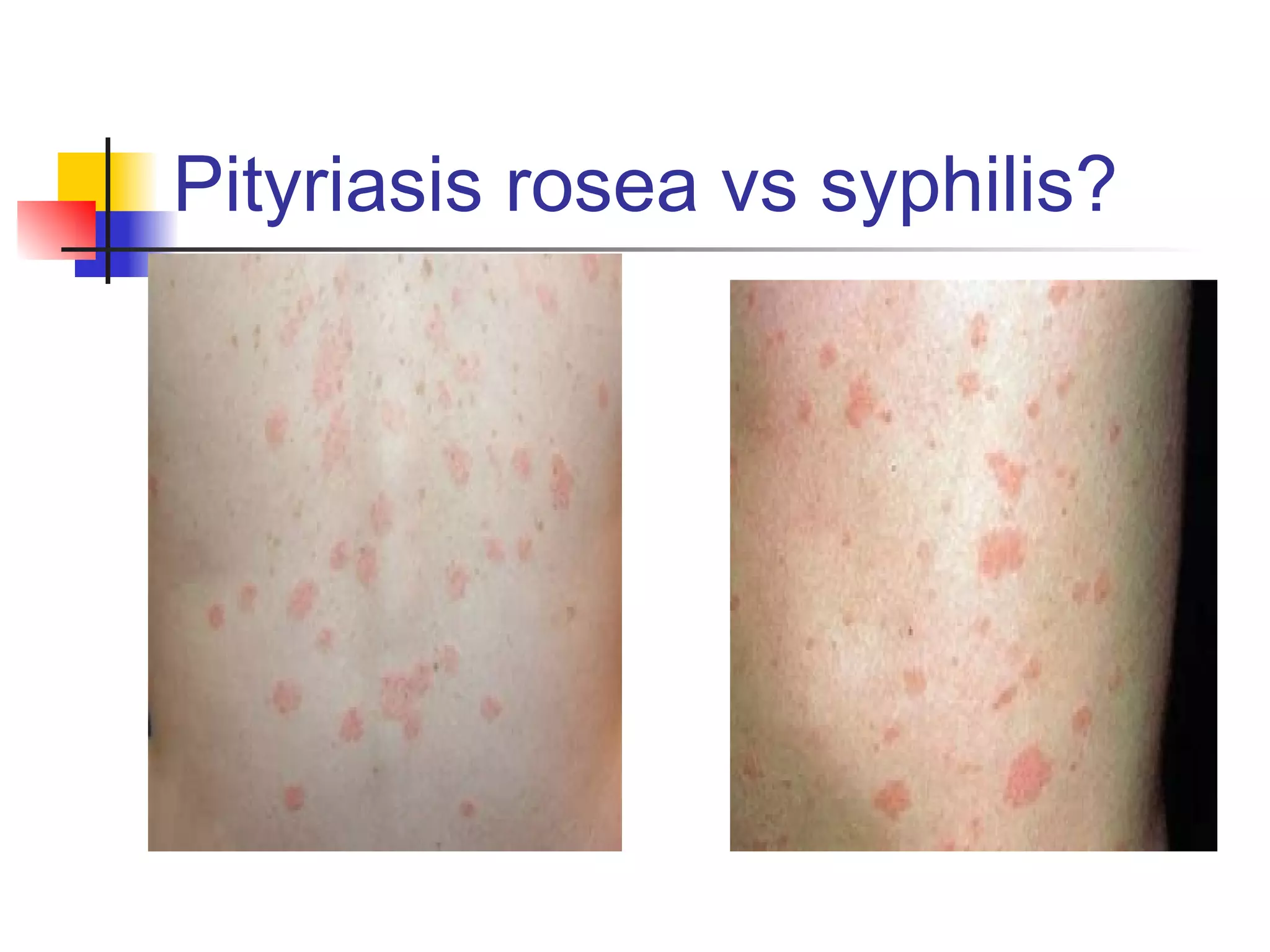 2ry Syphlis Rash Std noon conf 2019 | PPT