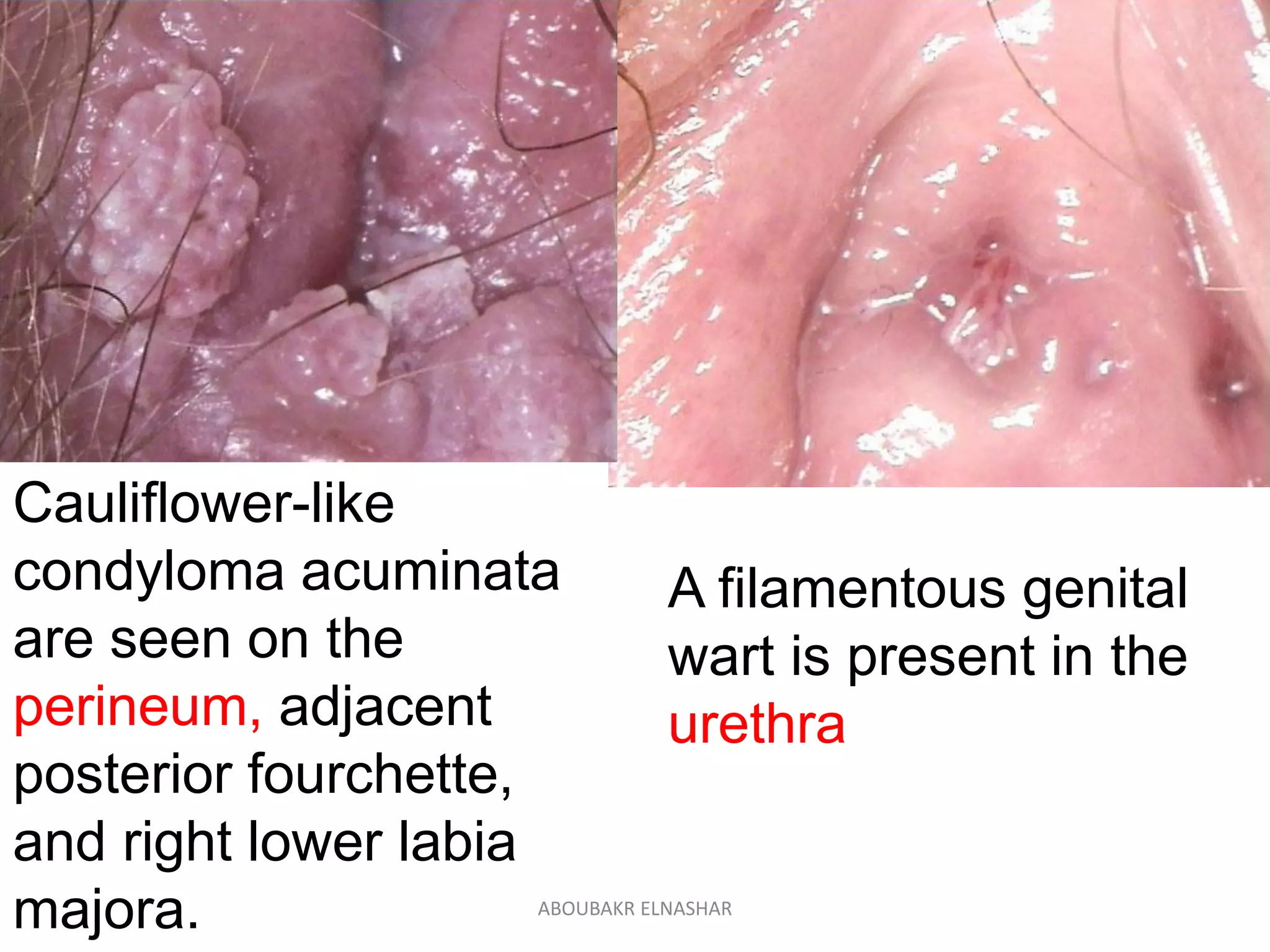 A filamentous genital
wart is present in the
urethra
Cauliflower-like
condyloma acuminata
are seen on the
perineum, adjacent
posterior fourchette,
and right lower labia
majora. ABOUBAKR ELNASHAR
 