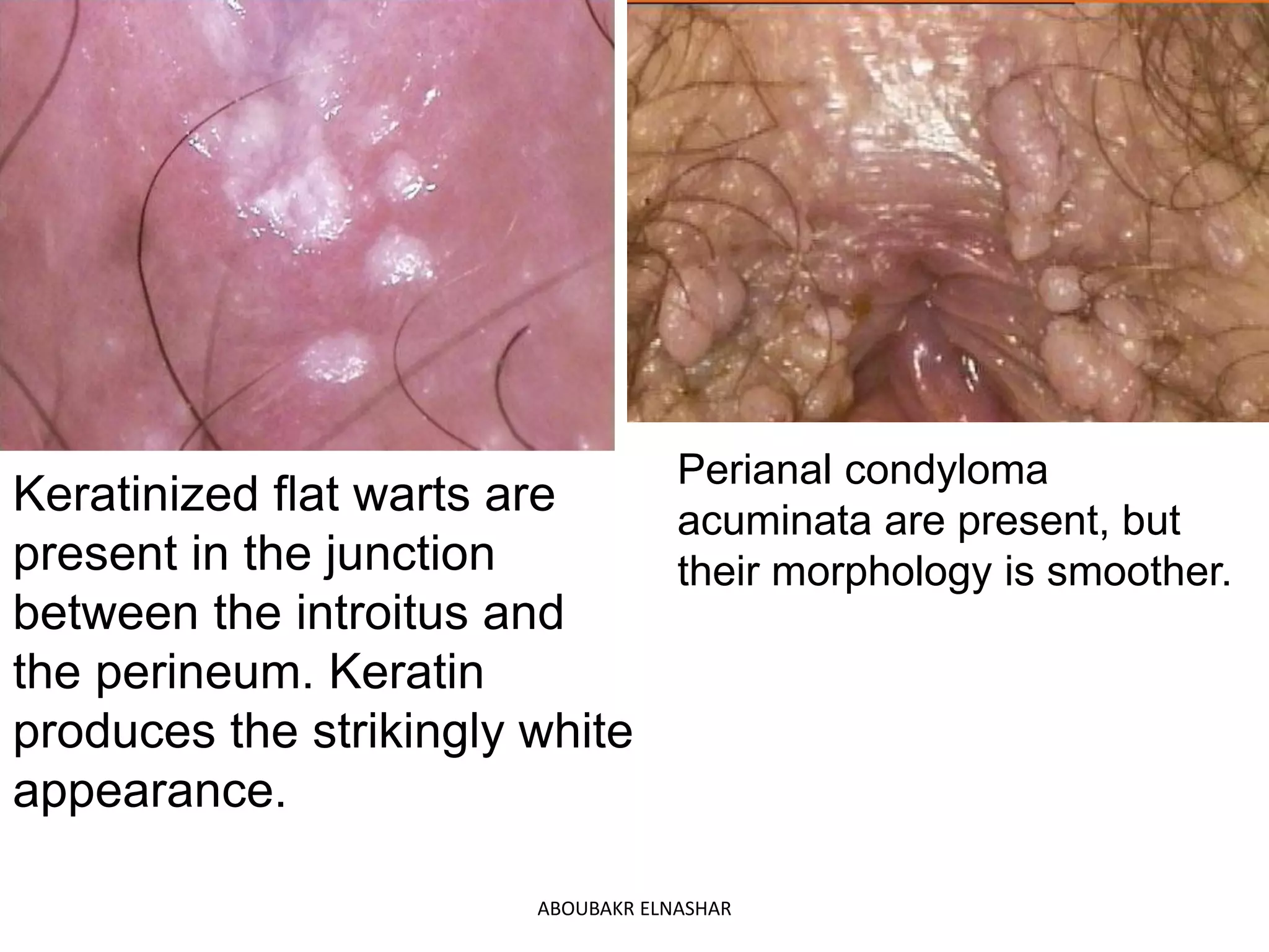 Perianal condyloma
acuminata are present, but
their morphology is smoother.
Keratinized flat warts are
present in the junction
between the introitus and
the perineum. Keratin
produces the strikingly white
appearance.
ABOUBAKR ELNASHAR
 