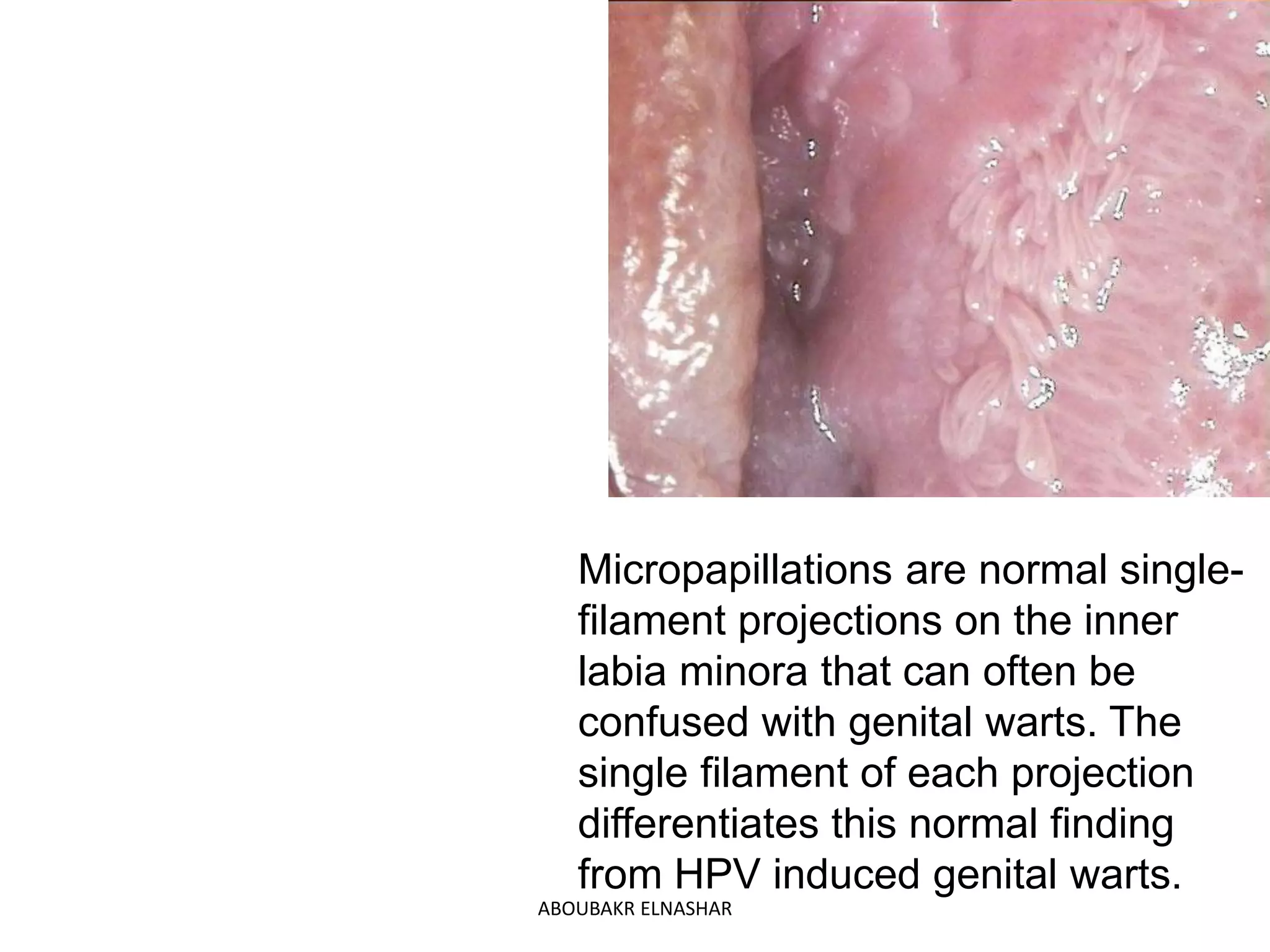 Micropapillations are normal single-
filament projections on the inner
labia minora that can often be
confused with genital warts. The
single filament of each projection
differentiates this normal finding
from HPV induced genital warts.
ABOUBAKR ELNASHAR
 