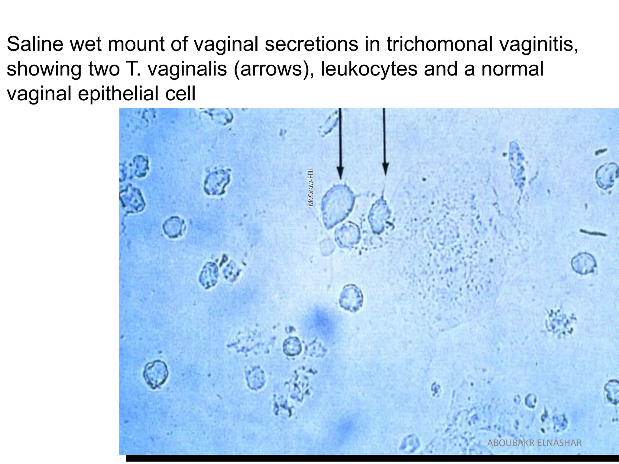 Saline wet mount of vaginal secretions in trichomonal vaginitis,
showing two T. vaginalis (arrows), leukocytes and a normal
vaginal epithelial cell
McGraw-Hill
ABOUBAKR ELNASHAR
 