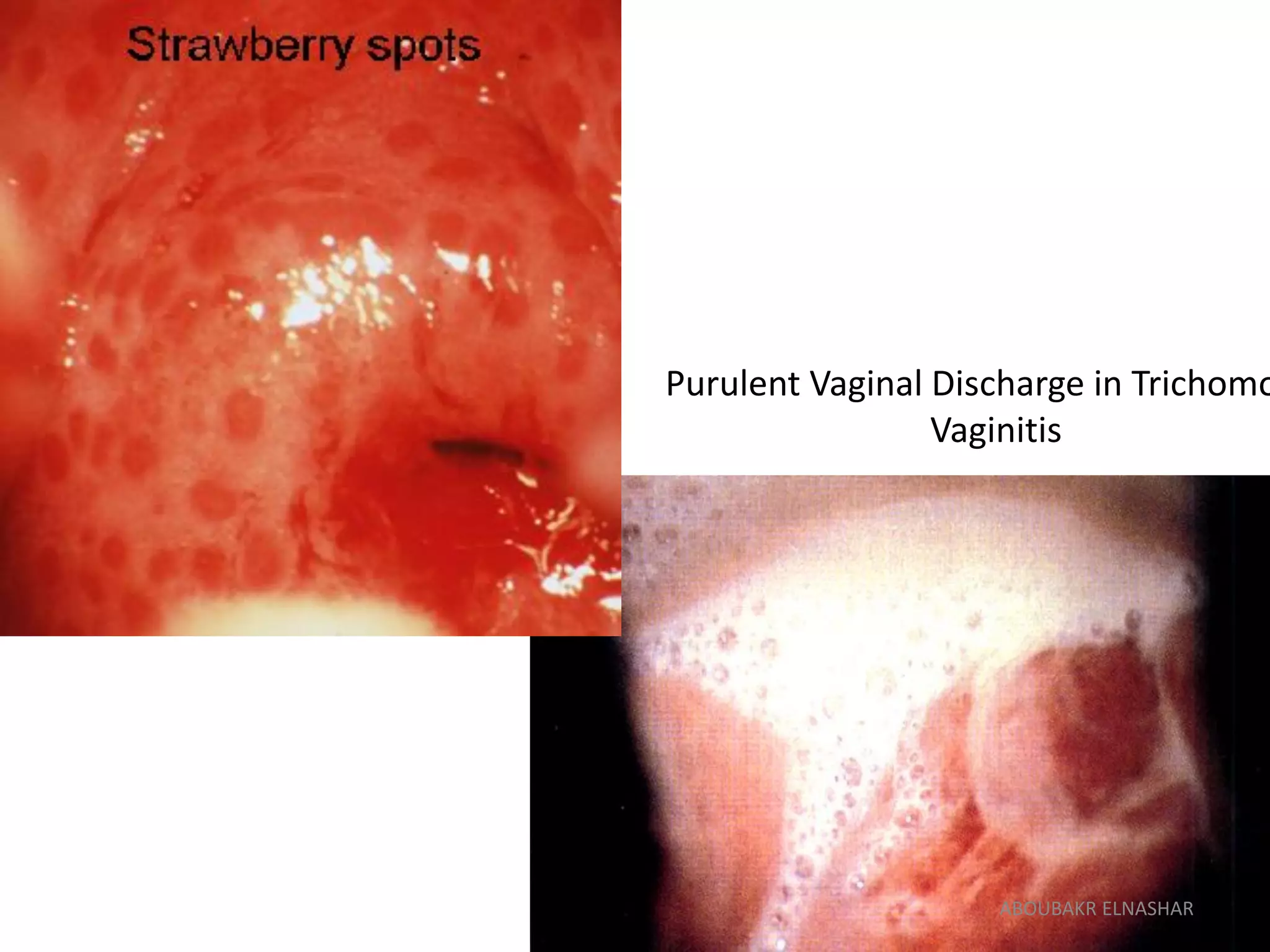 Purulent Vaginal Discharge in Trichomo
Vaginitis
McGraw-Hill
ABOUBAKR ELNASHAR
 