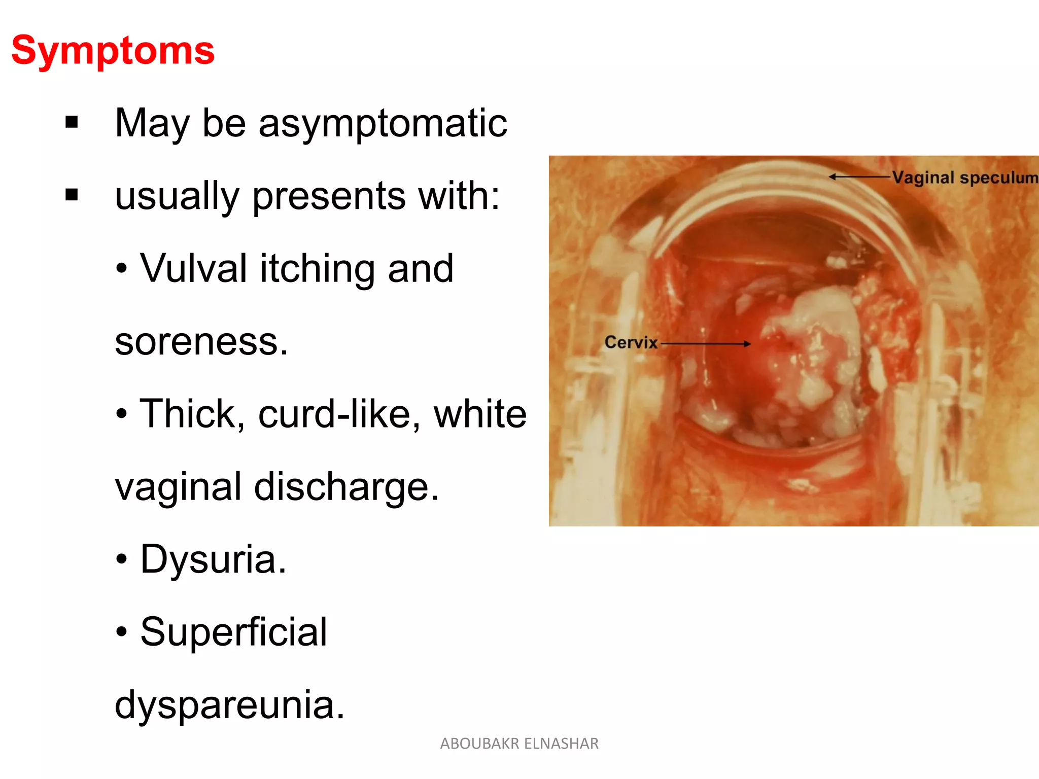 Symptoms
 May be asymptomatic
 usually presents with:
• Vulval itching and
soreness.
• Thick, curd-like, white
vaginal discharge.
• Dysuria.
• Superficial
dyspareunia.
ABOUBAKR ELNASHAR
 