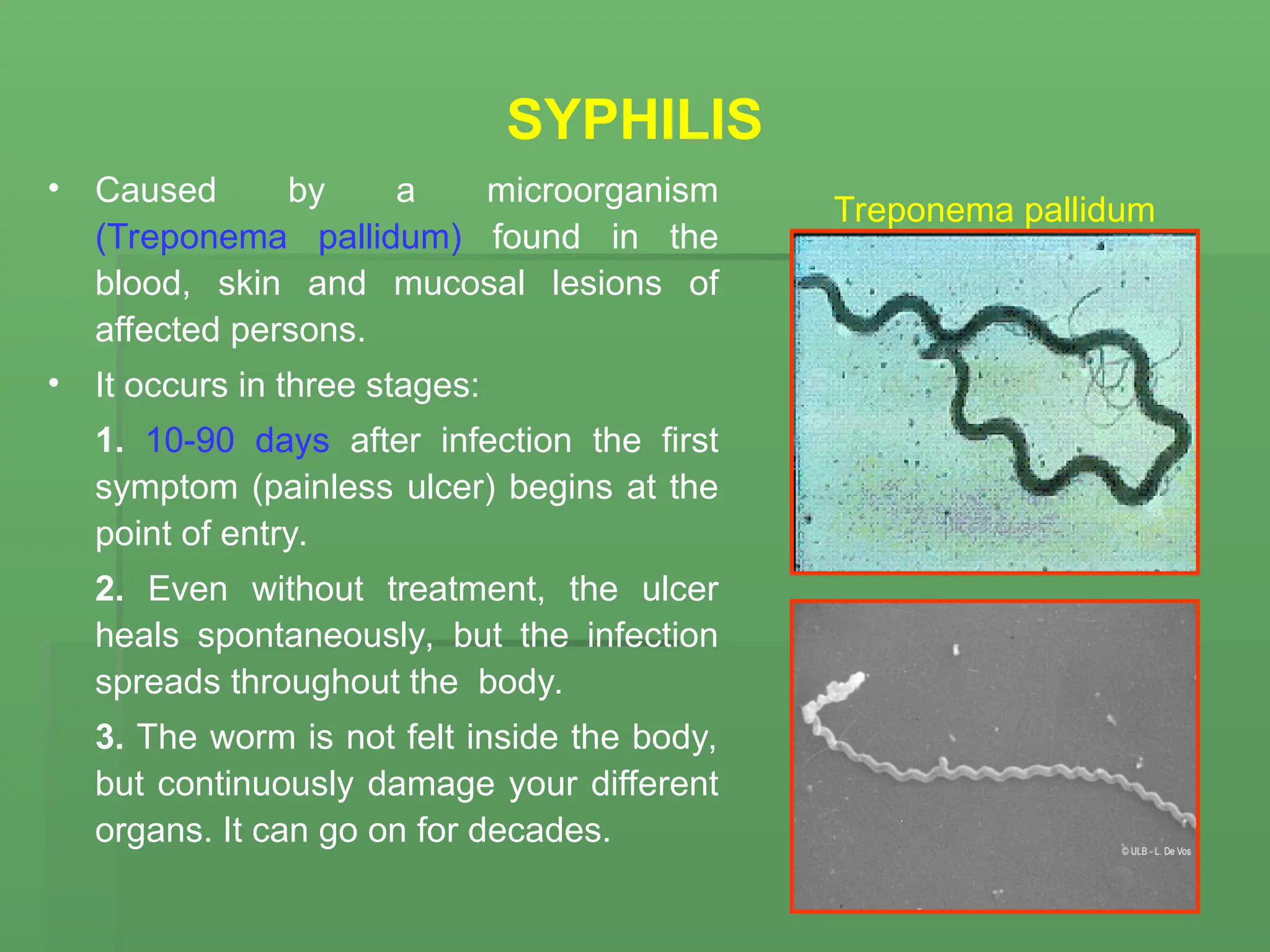 SYPHILIS
• Caused by a microorganism
(Treponema pallidum) found in the
blood, skin and mucosal lesions of
affected persons.
• It occurs in three stages:
1. 10-90 days after infection the first
symptom (painless ulcer) begins at the
point of entry.
2. Even without treatment, the ulcer
heals spontaneously, but the infection
spreads throughout the body.
3. The worm is not felt inside the body,
but continuously damage your different
organs. It can go on for decades.
Treponema pallidum
 