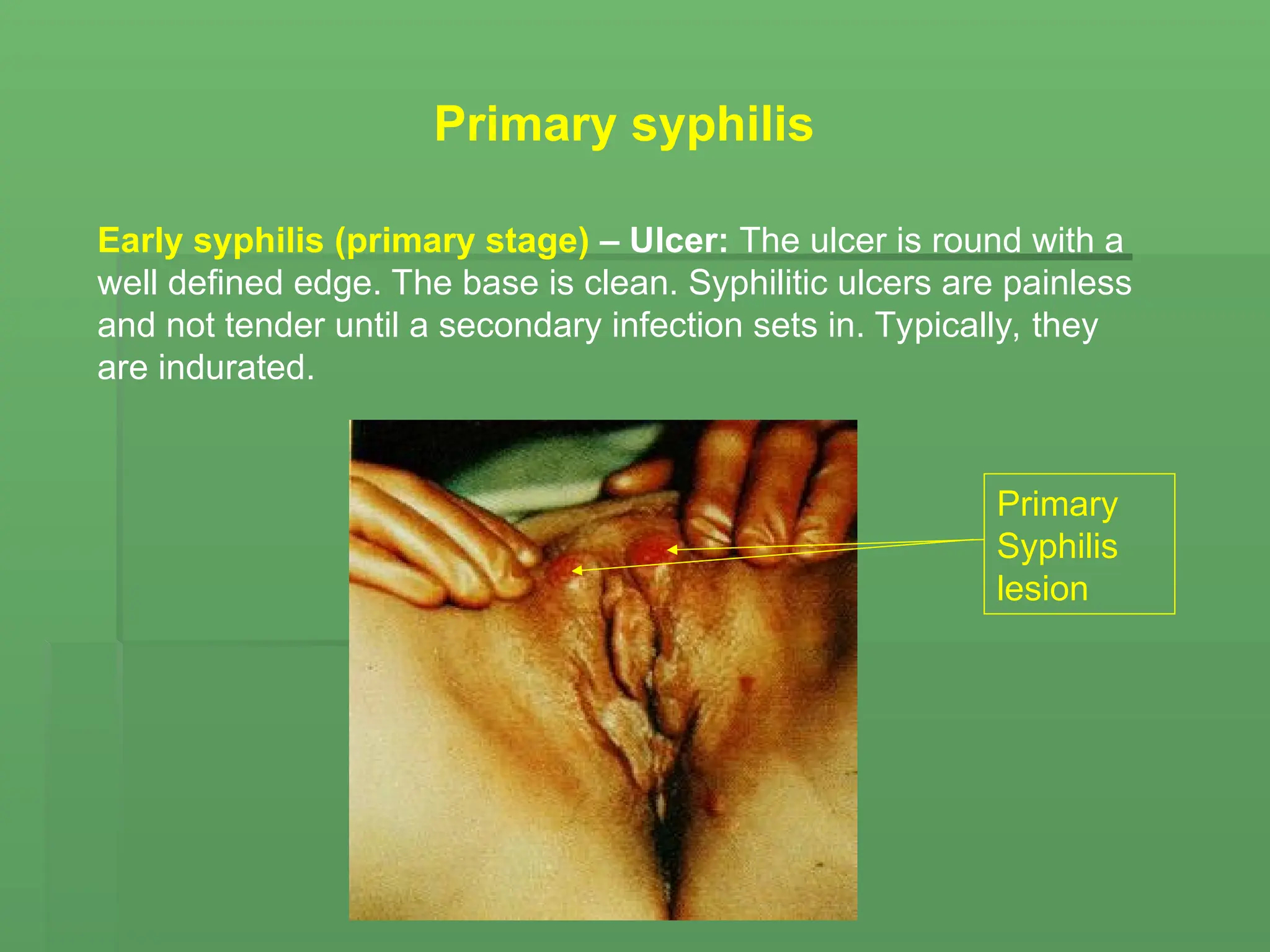 Early syphilis (primary stage) – Ulcer: The ulcer is round with a
well defined edge. The base is clean. Syphilitic ulcers are painless
and not tender until a secondary infection sets in. Typically, they
are indurated.
Primary syphilis
Primary
Syphilis
lesion
 