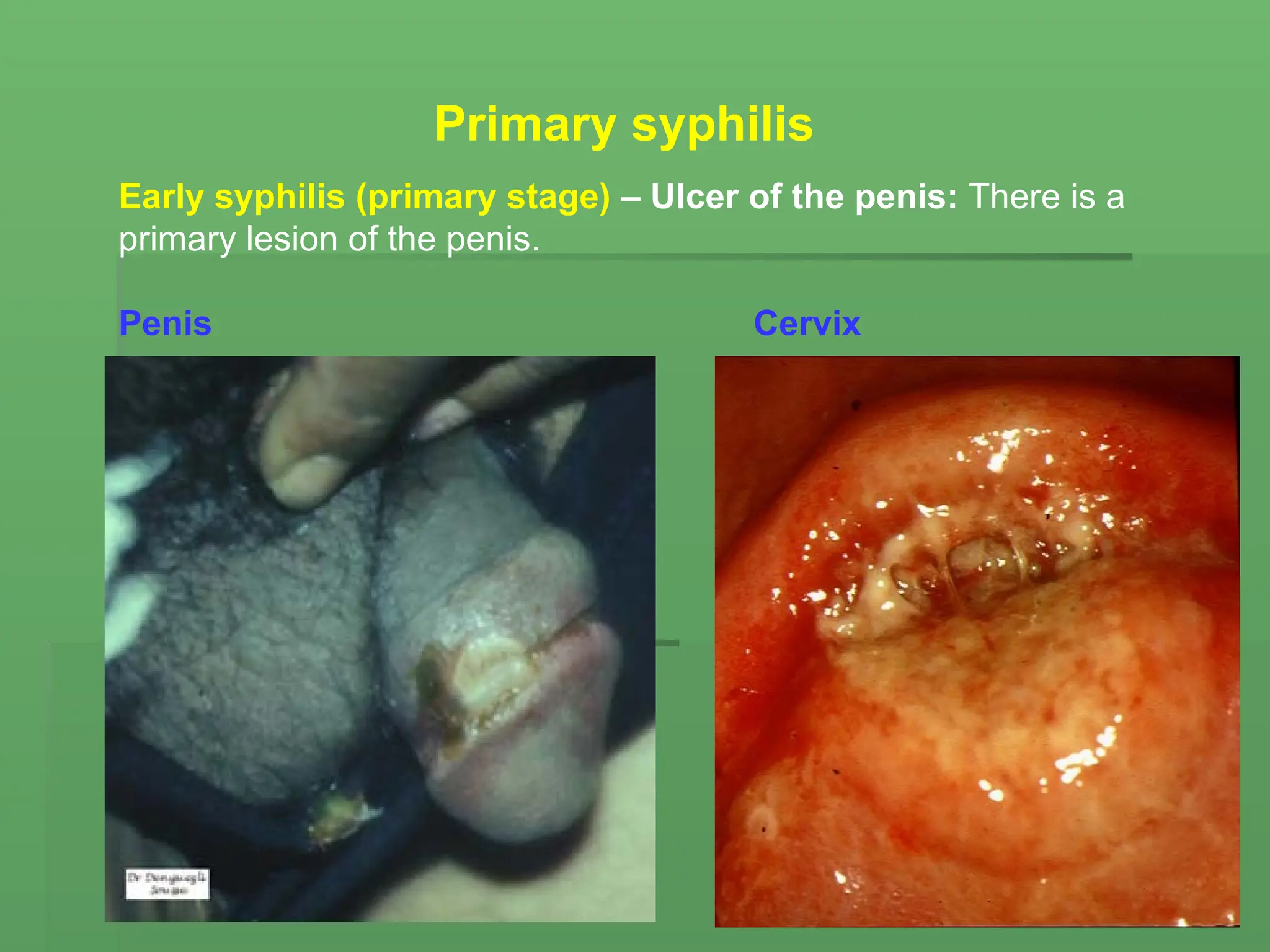 Early syphilis (primary stage) – Ulcer of the penis: There is a
primary lesion of the penis.
Penis Cervix
Primary syphilis
 