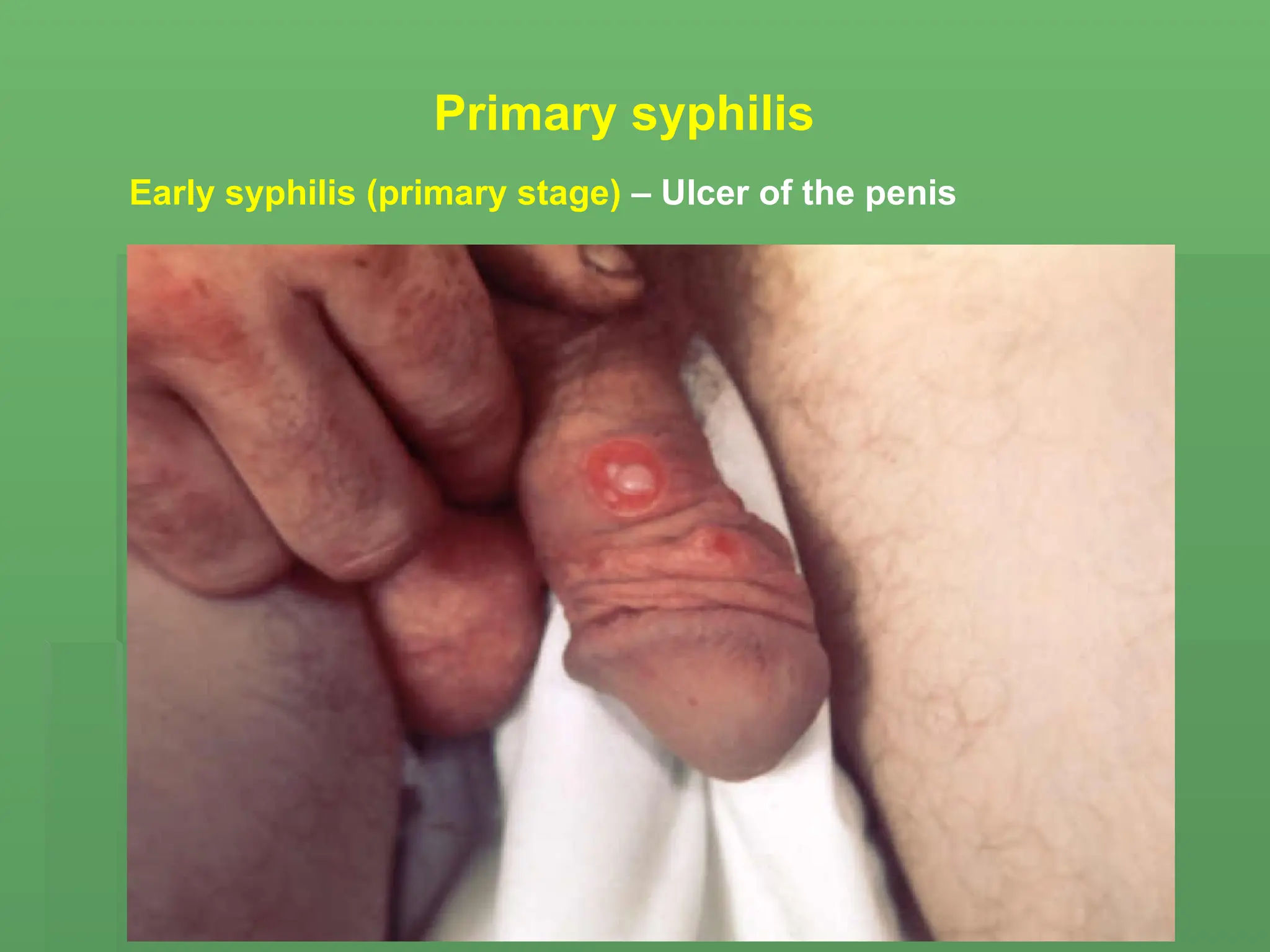 Early syphilis (primary stage) – Ulcer of the penis
Primary syphilis
 