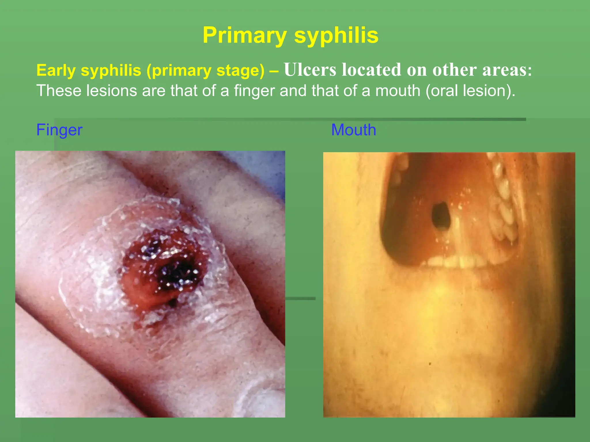 Early syphilis (primary stage) – Ulcers located on other areas:
These lesions are that of a finger and that of a mouth (oral lesion).
Finger Mouth
Primary syphilis
 
