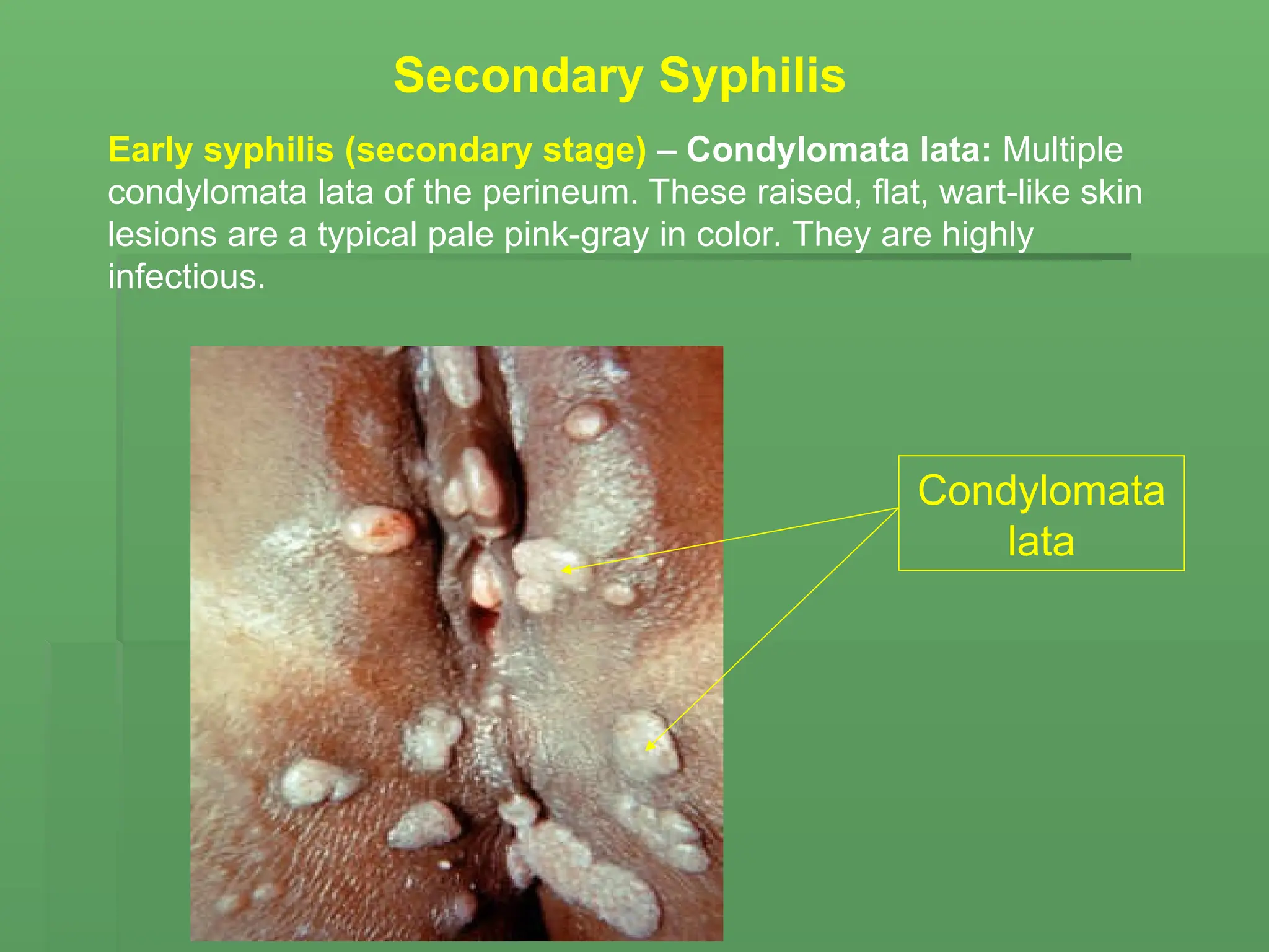 Early syphilis (secondary stage) – Condylomata lata: Multiple
condylomata lata of the perineum. These raised, flat, wart-like skin
lesions are a typical pale pink-gray in color. They are highly
infectious.
Secondary Syphilis
Condylomata
lata
 