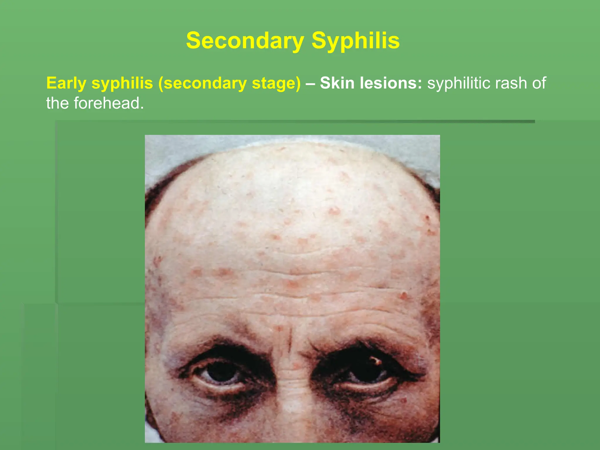 Early syphilis (secondary stage) – Skin lesions: syphilitic rash of
the forehead.
Secondary Syphilis
 