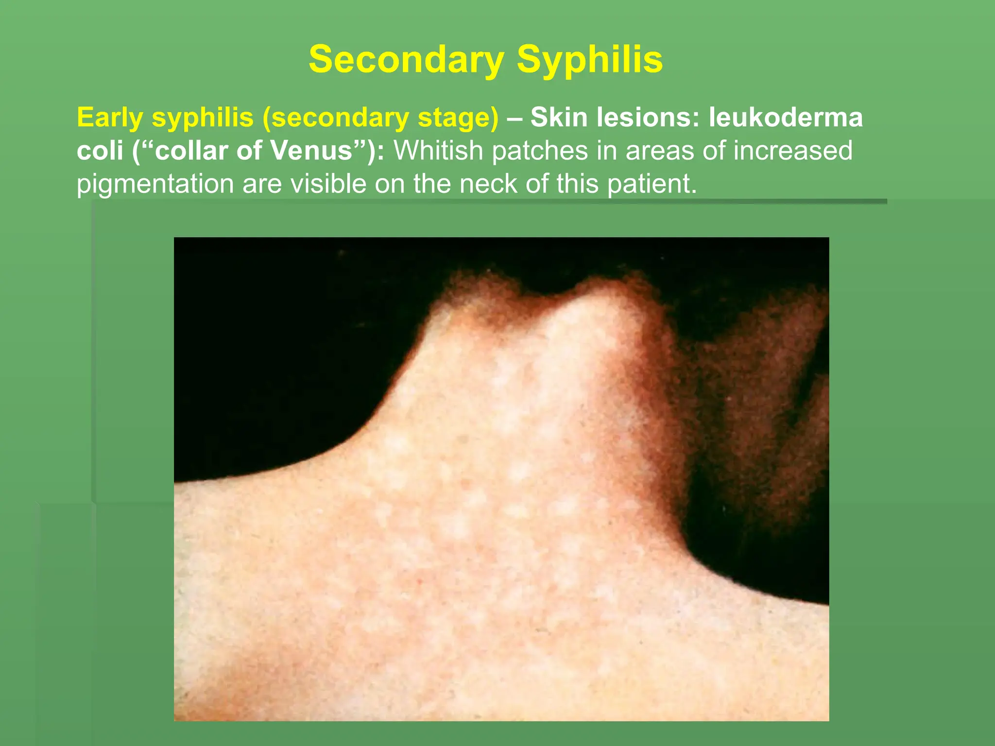 Early syphilis (secondary stage) – Skin lesions: leukoderma
coli (“collar of Venus”): Whitish patches in areas of increased
pigmentation are visible on the neck of this patient.
Secondary Syphilis
 