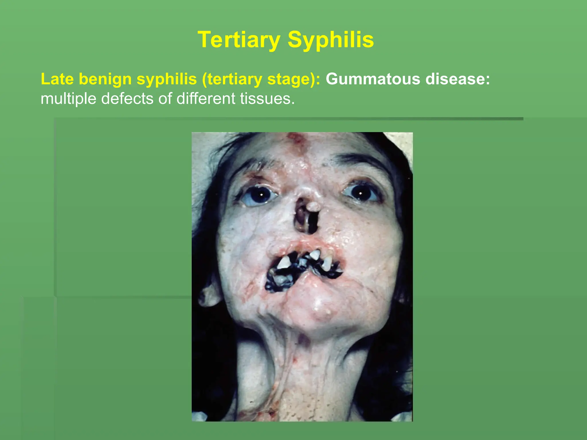 Late benign syphilis (tertiary stage): Gummatous disease:
multiple defects of different tissues.
Tertiary Syphilis
 