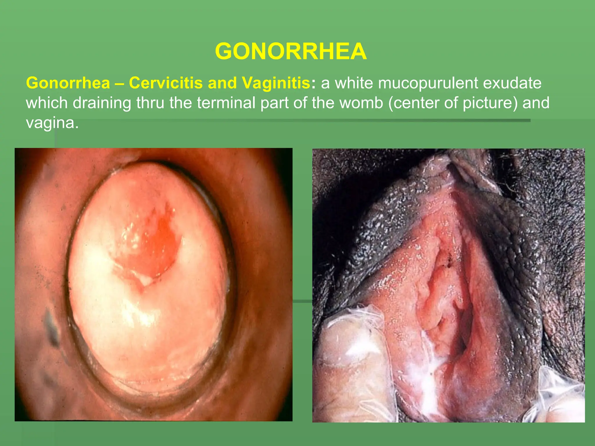 Gonorrhea – Cervicitis and Vaginitis: a white mucopurulent exudate
which draining thru the terminal part of the womb (center of picture) and
vagina.
GONORRHEA
 